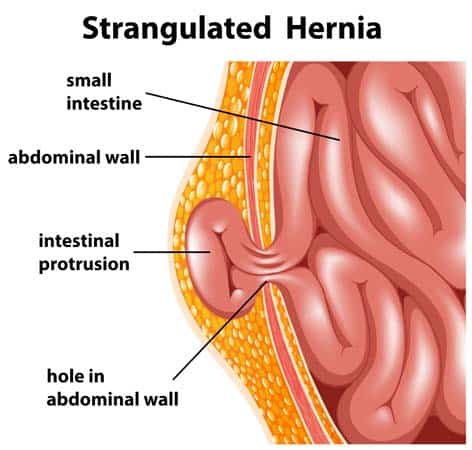 Diagram of strangulated hernia. Photo credit: depositphotos/blueringmedia 